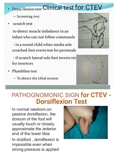 scratch test ctev|What is CTEV (Clubfoot) .